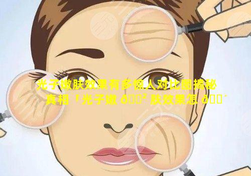 光子嫩肤效果有多惊人对比图揭秘真相「光子嫩 🌲 肤效果怎 🌴 么样,好吗」